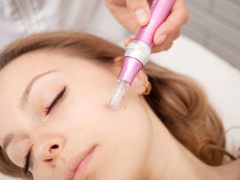 Microneedling con acido ialuronico e complessi vitaminici